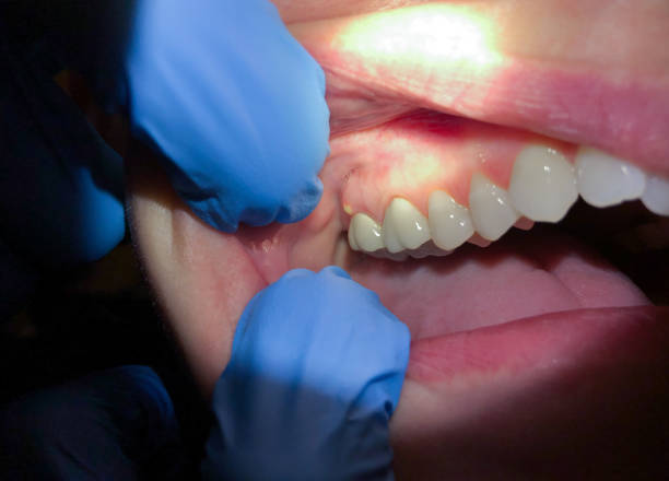 Best Cracked Tooth Emergency Dentist  in Wesleyville, PA